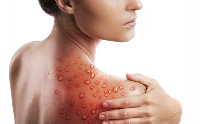 Rashes: Seeking Relief from Allergic Reactions