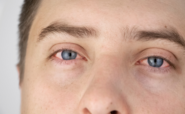 Which Measures Can Cure Eye Flu?