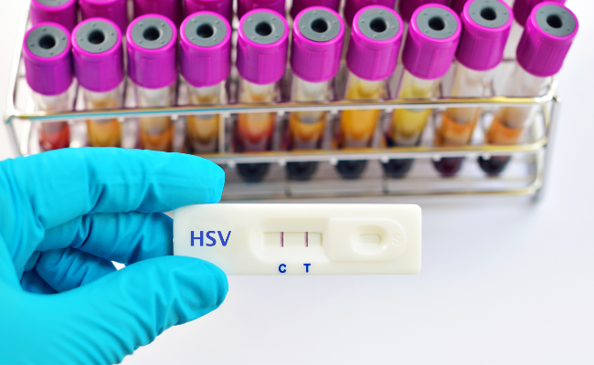 Could HSV-1 Explain My Genital Symptoms?