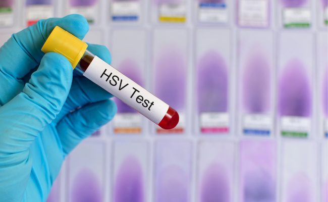 Are HSV transmission risks higher for immunocompromised?