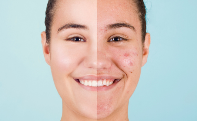 Acne: Causes, Management, and Treatment