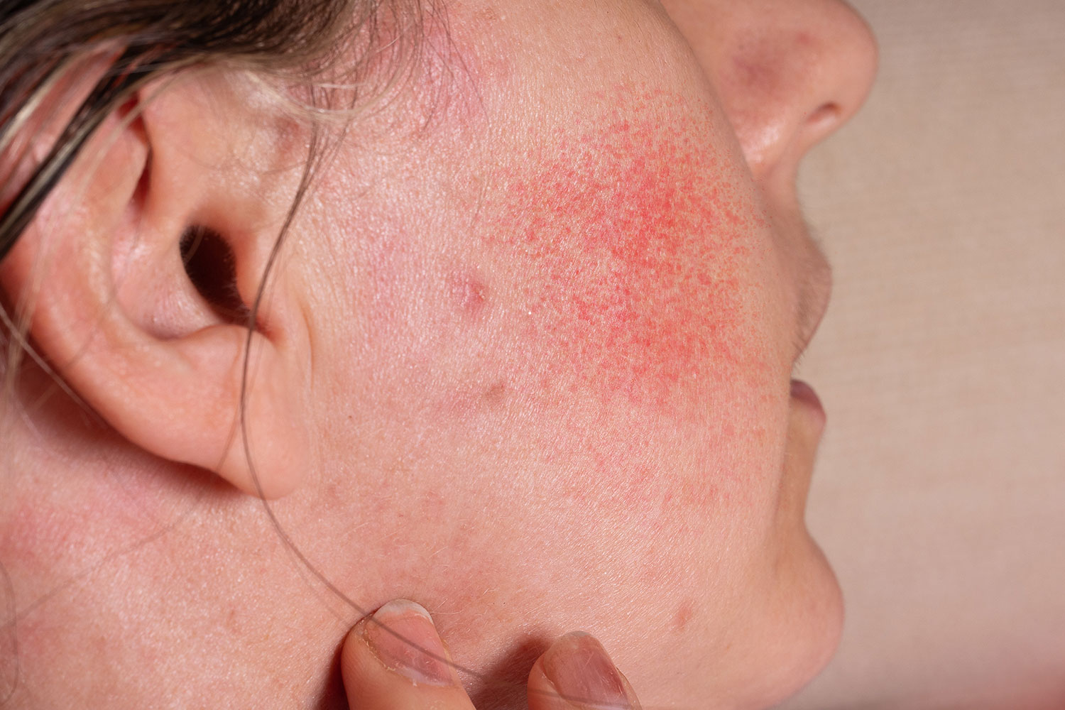 Possible Link Between Face Rash and Recent Micro needling Session