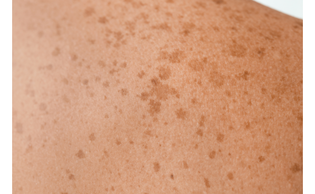 Pinpoint Skin Dots: Causes and Care