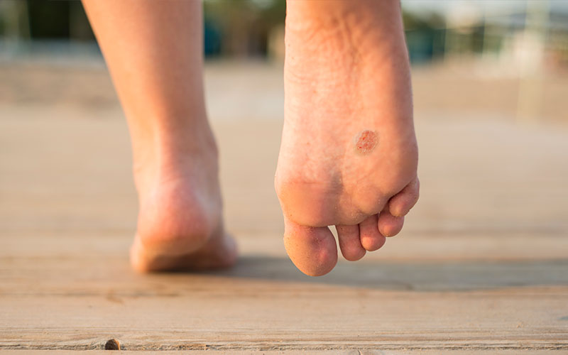 Surgical Solutions: Minimizing Scars from Foot Birthmark