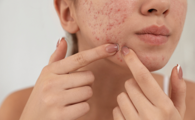 What's the Best Acne Treatment Option?