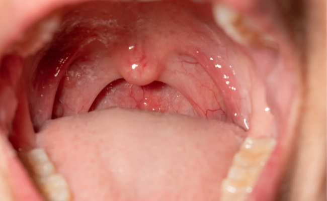 Pharyngeal Wall Mucosal Hypertrophy: Causes, Management