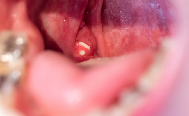 Tonsil Stones: Causes, Treatment, Prevention
