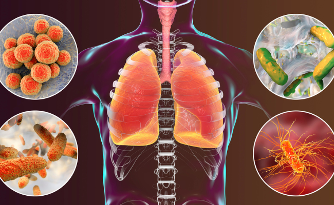 What Signals Severe Flu or Pneumonia?