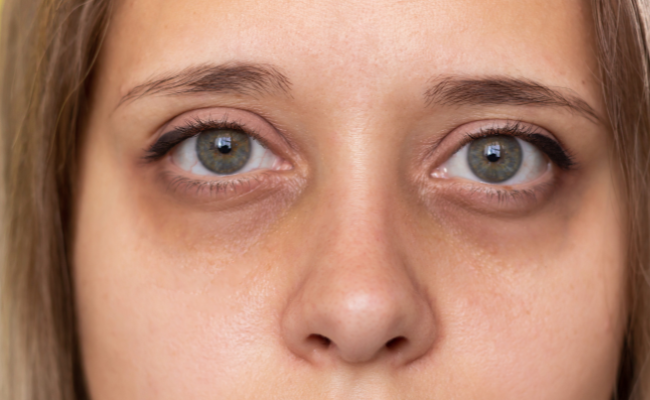 Primary Factors Contributing to Dark Circles Under Eyes