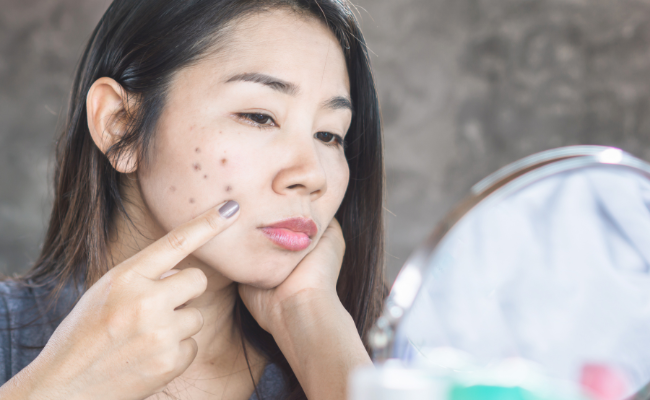 Treating Post-Pimple Dark Spots: Solutions and Prevention Tips