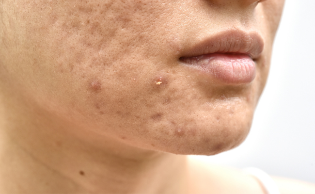 Struggling with Acne, Dark Spots, Large Pores, and Hyperpigmentation: Seeking Effective Solutions