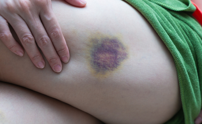 What Causes Painful Leg Bruises?