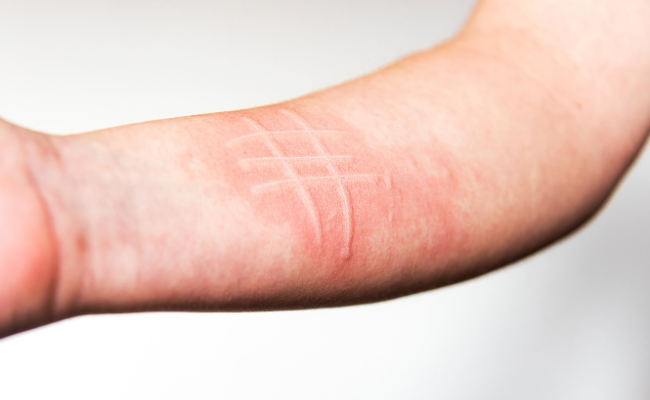 Need Dermatographism Relief? Get Expert Advice for Fast Recovery!