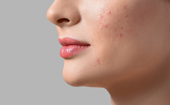 Expert Solutions for Pimples & Dark Spots