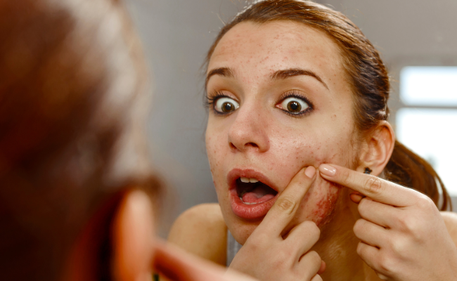 Struggling with Pimple Removal Burns? Get Expert Advice Now!