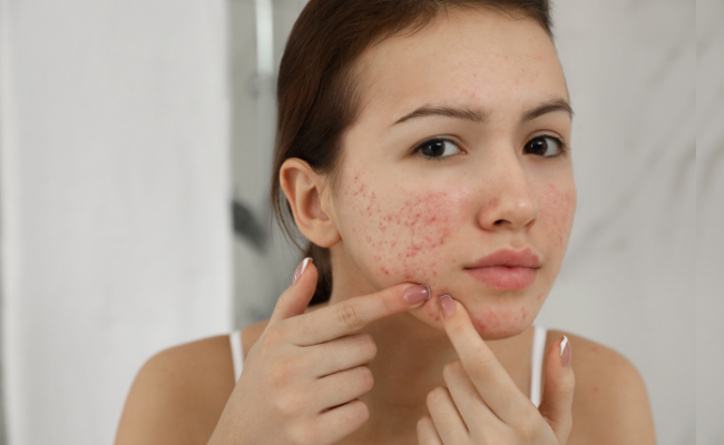 Get Clear Skin: Expert Tips for Treating Pimples