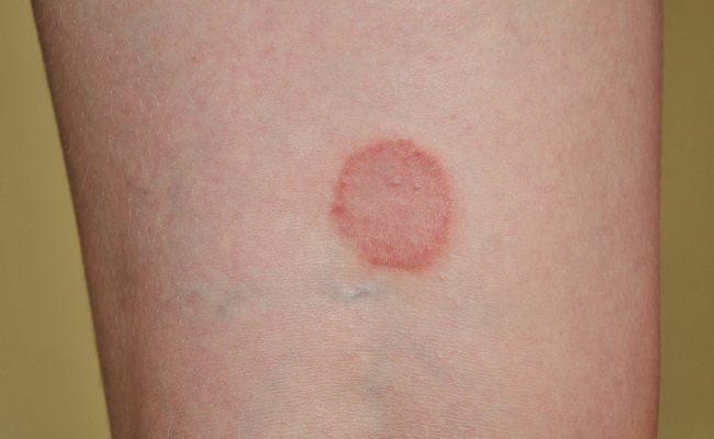 Struggling with Ringworm? Get Expert Help Now!
