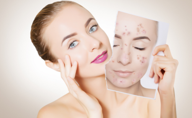 Concerned About Acne on Oily Skin? Find Answers Here!