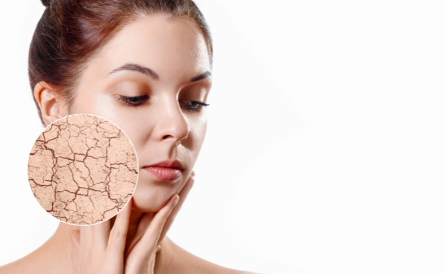 Struggling with Acne on Dry Skin? Discover Expert Solutions Now!