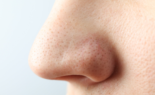 Wondering About Nose Pigmentation? Get Expert Advice Now!