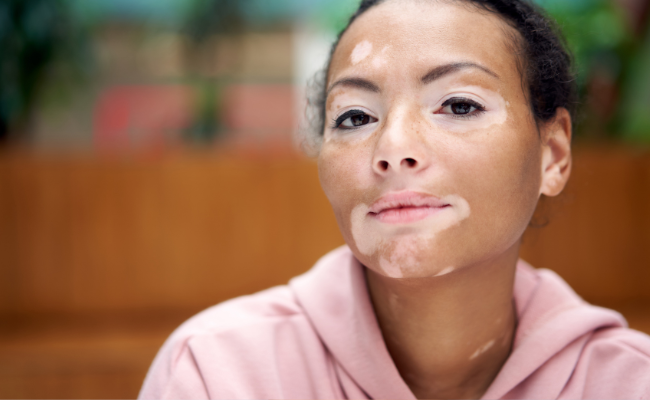 Are You Struggling with Skin Pigment Problems? Get Help Today!