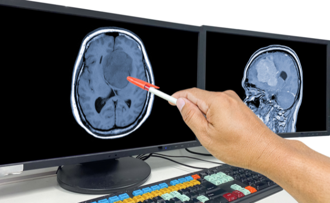 Confused About Benign vs. Malignant Tumors? Understand Metastasis Today!