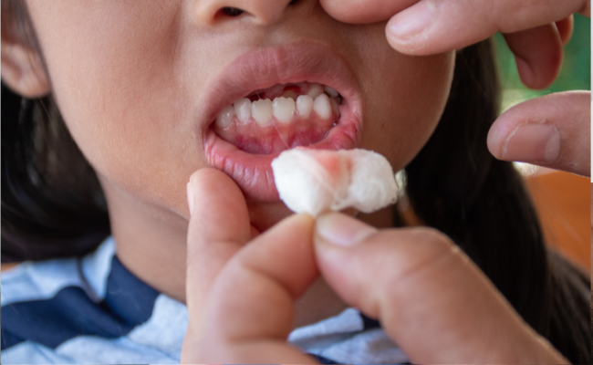 How to Stop Bleeding Gums: Effective Solutions and Tips