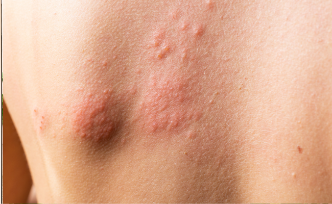 Itchy Blisters and Positive Syphilis Test: Get Expert Advice